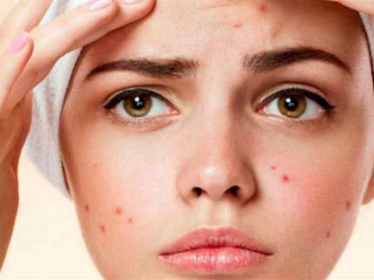 Загорнути кубики льоду в&nbsp;тканину і&nbsp;прикласти: прості лайфхаки, як&nbsp;позбутись прищів